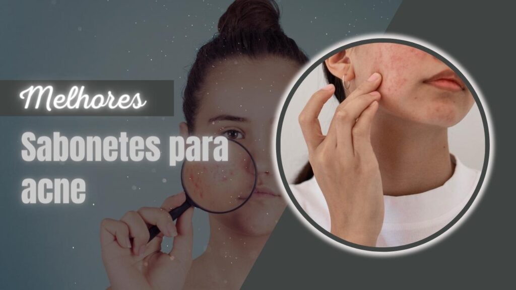 Melhores Sabonetes Para Acne (2)